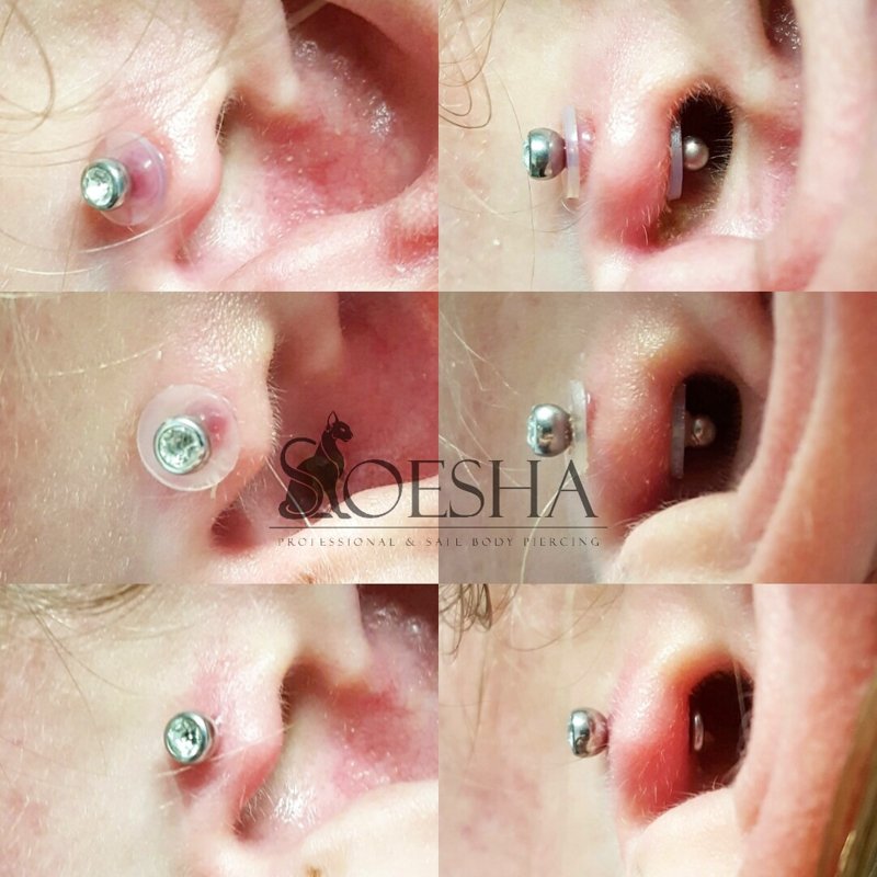 NoPull Piercing Disc®️ pulled away from the scarring, only to show the  progress of healing. Worn with Gentle, but Direct contact until  completely, By NoPull Piercing Co.